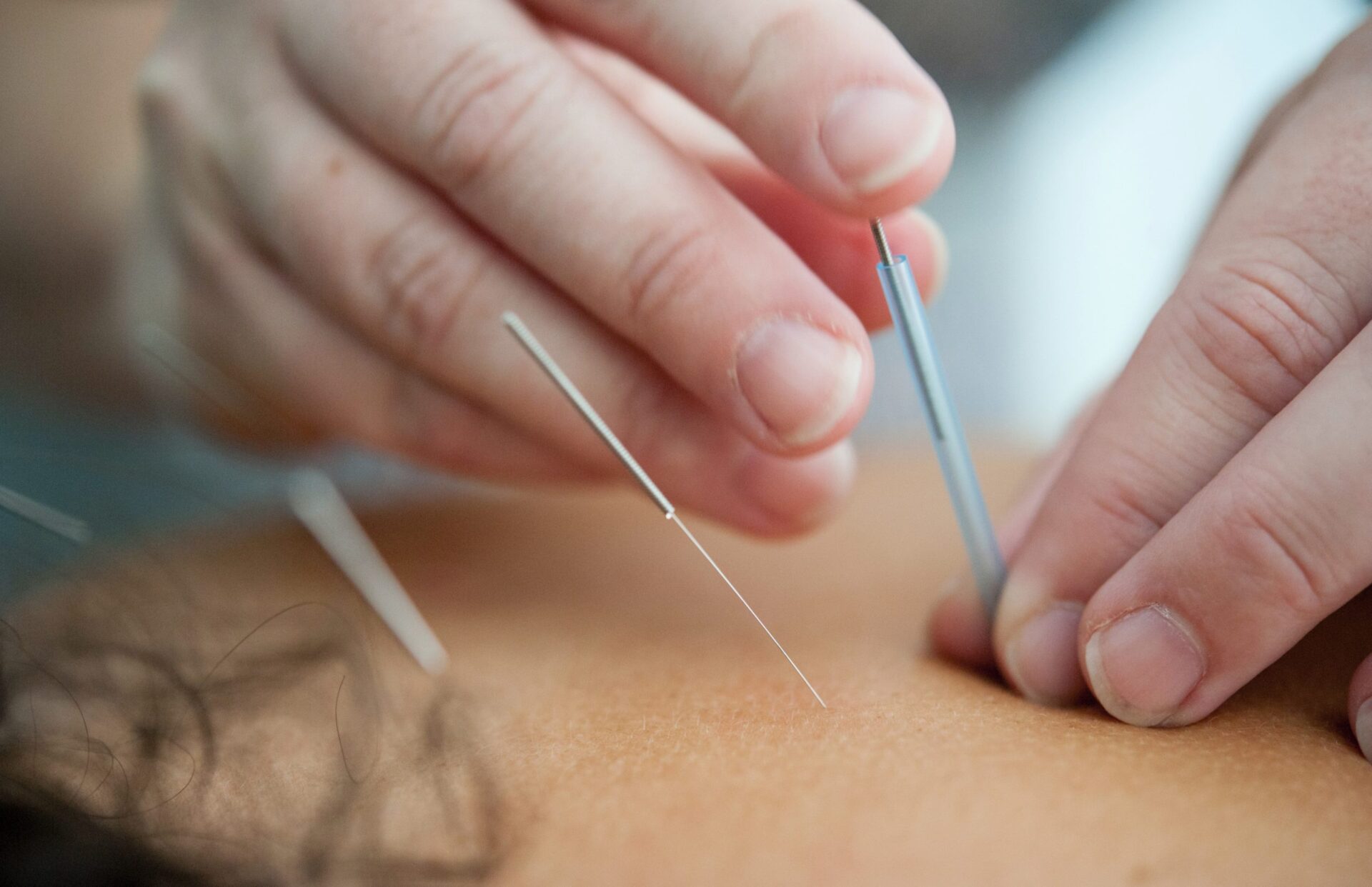 Can Acupuncture Relieve Sciatica Pain?