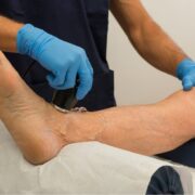 Laser Therapy for Foot Pain London